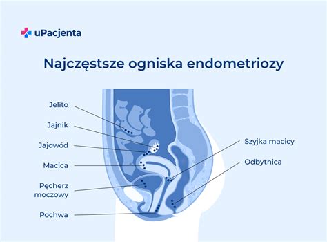 czy przy endometriozie może się spóźniać okres|Objawy endometriozy. Gdzie boli i po czym poznać, że to。